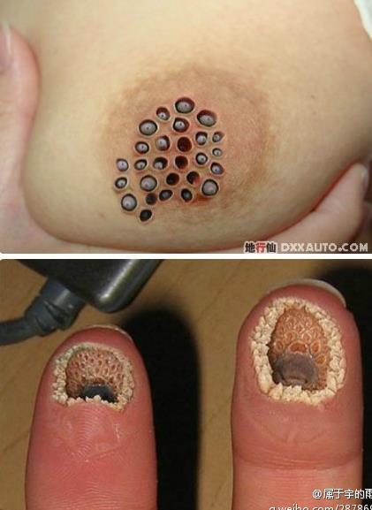 猴痘症状图片密集恐惧症，为什么我们看了会不适，又该如何正确应对？