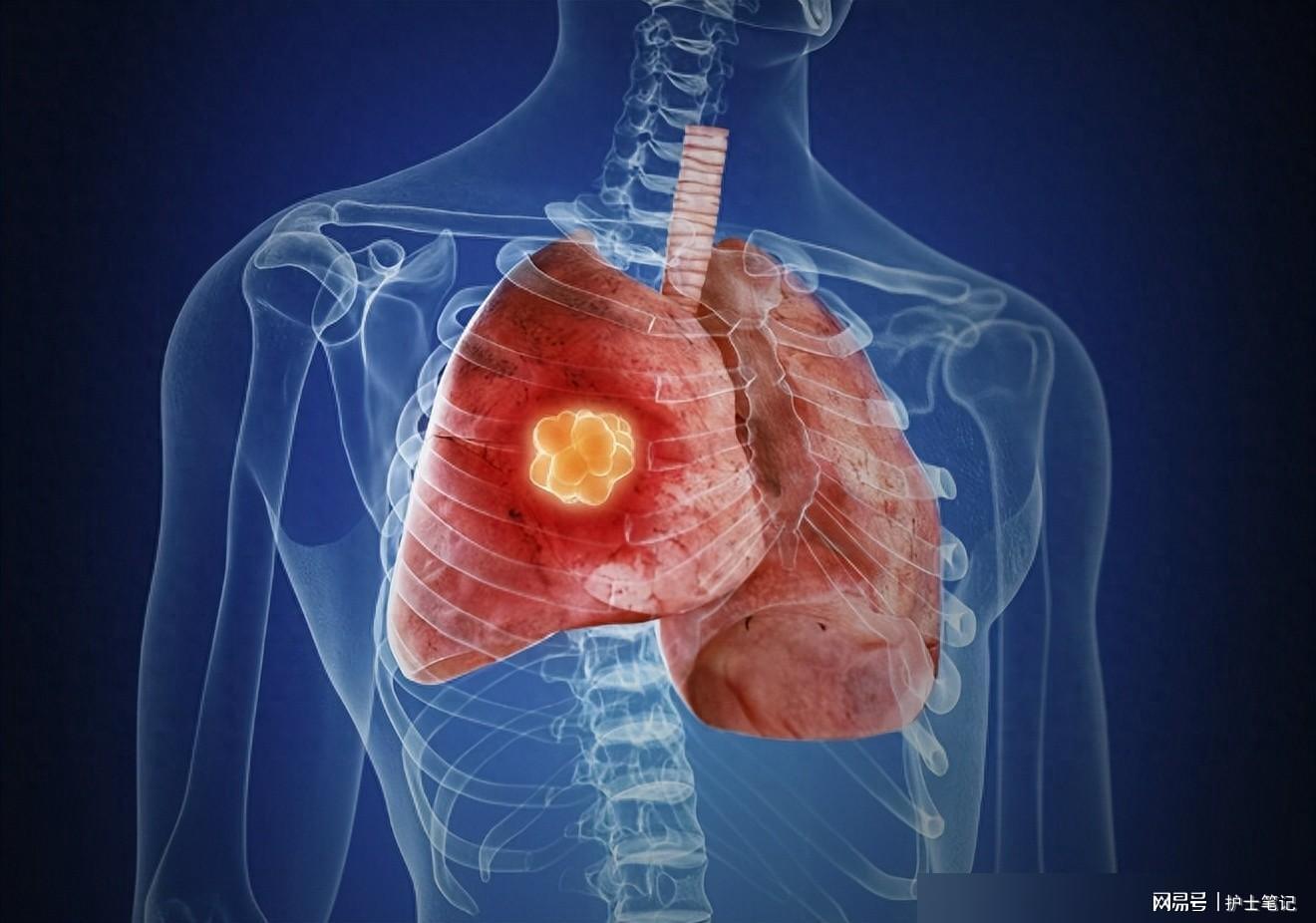 肺癌患者感染肺炎，能治好吗？