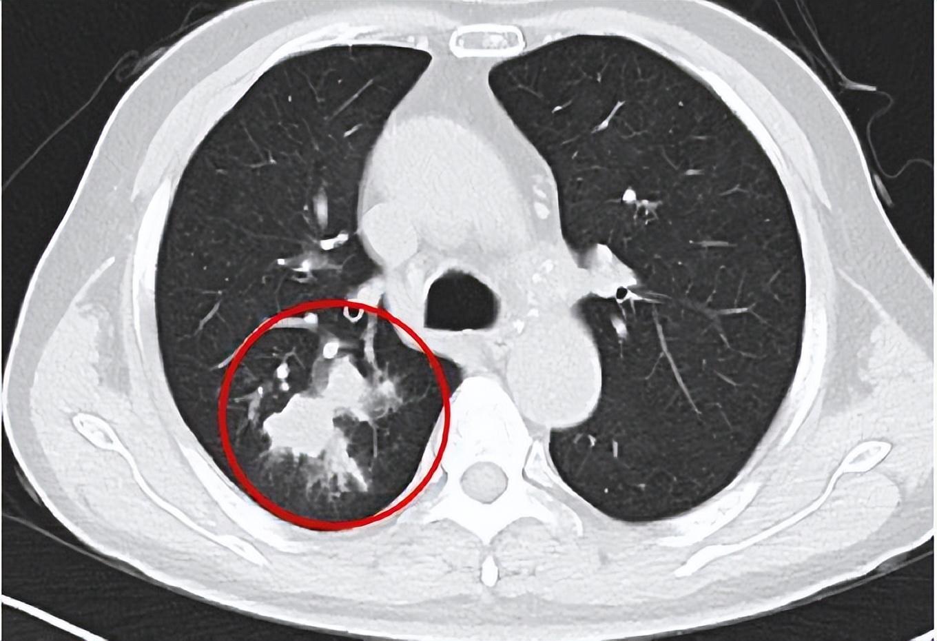 新冠疫苗有了第二代？权威回应来了！