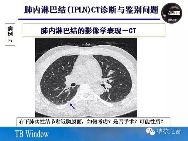 CT值-35HU严重么？解读肺部CT中的小白点