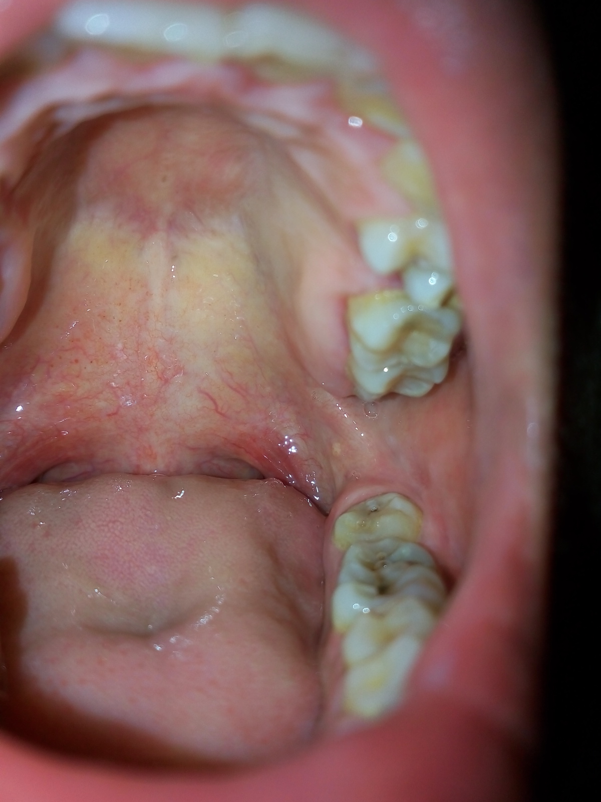 喉咙痒属于新型肺炎嘛？了解症状差异，科学应对