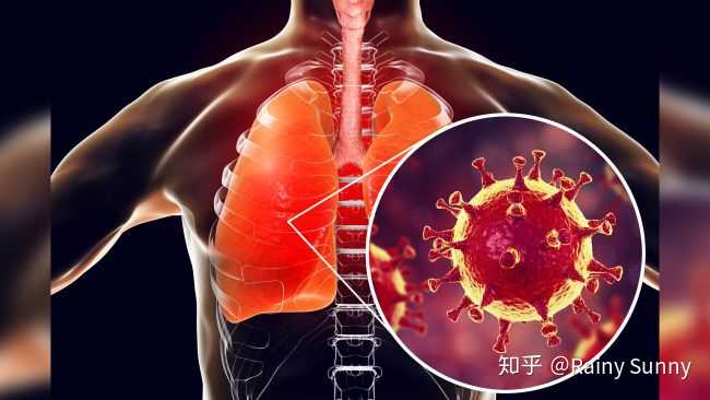 新增肺炎是指多久的肺炎？理解新增概念与肺炎病程的关系