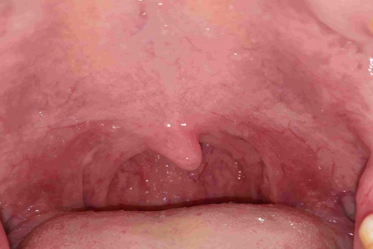 新冠喉咙痛会持续多久？详解病程与缓解方法