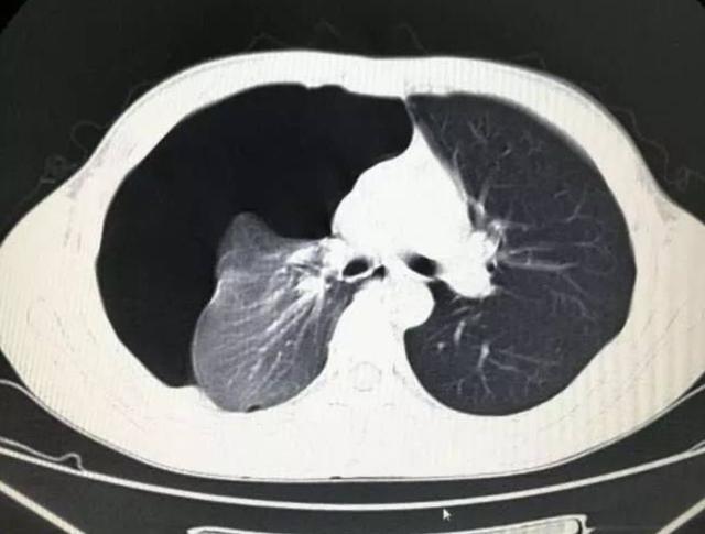 白肺现象，当呼吸被蒙上阴影